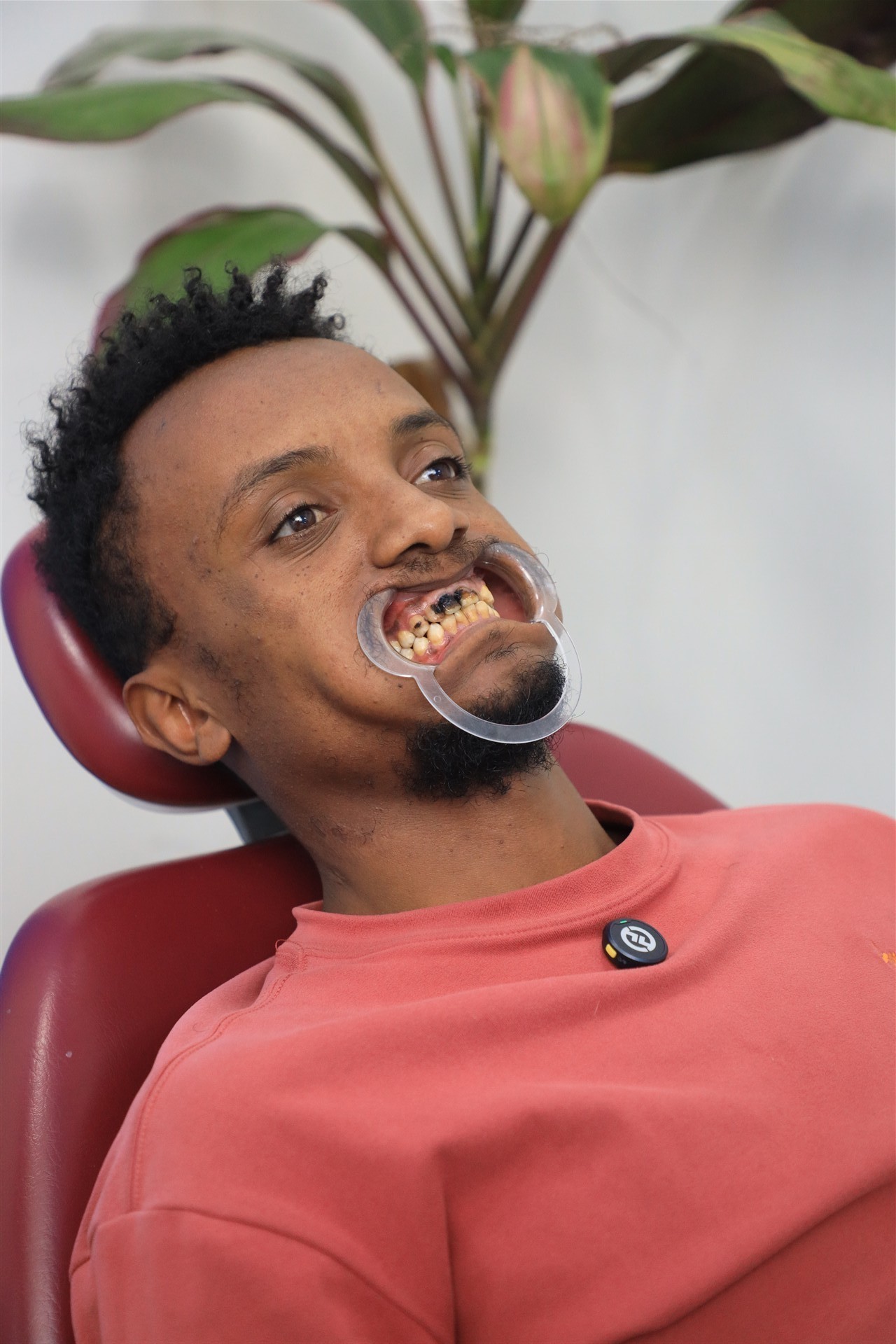 Before cosmetic dental treatment at Grace Dental